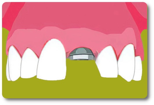 Implants dentaires Crolles