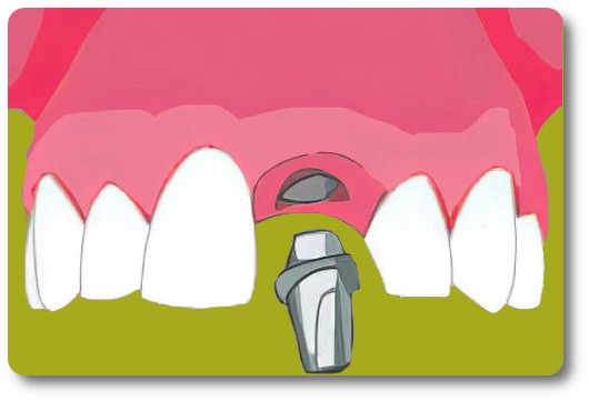 Implants dentaires Crolles