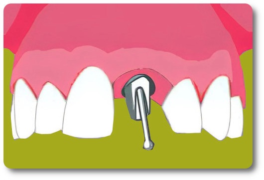 Implants dentaires Crolles
