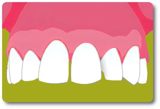 Implants dentaires Crolles
